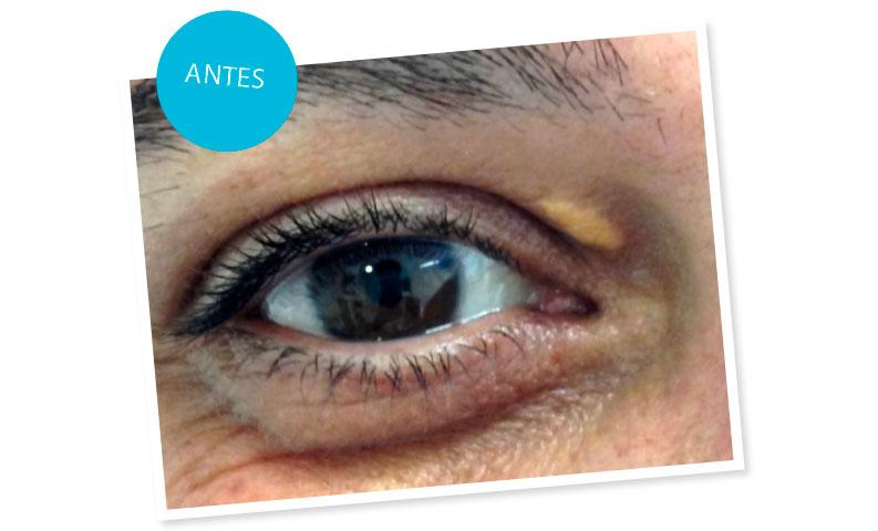 Hola mamá - Xantelasmas - antes